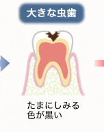 大きな虫歯：たまにしみる色が黒い