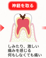 神経を取る：しみたり、激しい痛みを感じる何もしなくても痛い